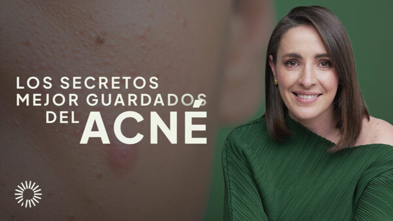 <p><big><strong>&iquest;Harto de que el acn&eacute; te robe la confianza y te haga sentir atrapado en un ciclo interminable de brotes y frustraci&oacute;n?</strong></big></p>

<p>Imagina tu rostro como un lienzo en blanco, listo para expresar tu belleza &uacute;nica. Pero, en lugar de colores vibrantes y trazos suaves, el acn&eacute; ha pintado un cuadro de imperfecciones, enrojecimiento y cicatrices. Has probado innumerables productos, cremas y tratamientos, pero nada parece funcionar a largo plazo. Te sientes atrapado en un ciclo interminable de brotes y frustraci&oacute;n, ocultando tu rostro y evitando situaciones sociales. &iquest;Pero qu&eacute; pasar&iacute;a si te dijera que hay una salida? &iquest;Y si te revelara los secretos mejor guardados sobre el acn&eacute;, esos que la industria de la belleza no quiere que sepas?</p>

<p><big><strong>La Historia del Guerrero de la Piel:</strong></big></p>

<p>Imagina a un valiente guerrero enfrentando un drag&oacute;n feroz. El drag&oacute;n escupe fuego, dejando cicatrices y quemaduras en la piel del guerrero. Pero, en lugar de rendirse, el guerrero busca el conocimiento ancestral, las hierbas medicinales y las t&eacute;cnicas de combate secretas para vencer al drag&oacute;n y sanar sus heridas. El acn&eacute; es como ese drag&oacute;n, un desaf&iacute;o que requiere valent&iacute;a, conocimiento y perseverancia para ser superado.</p>

<p><strong><big>&iquest;Est&aacute;s listo para convertirte en el guerrero de tu piel y luchar contra el acn&eacute; con estrategias efectivas y duraderas? &iquest;Quieres descubrir las causas ocultas, los mitos y las verdades, y las soluciones reales que te permitir&aacute;n recuperar la confianza en tu rostro y vivir una vida libre de imperfecciones</big>?</strong></p>

<p><big><strong>Mitos y Verdades sobre el Acn&eacute;: Desenmascarando las Mentiras</strong></big></p>

<ul>
	<li>Mito: El acn&eacute; es solo un problema de adolescentes. Verdad: El acn&eacute; puede afectar a personas de todas las edades, desde beb&eacute;s hasta adultos mayores.</li>
	<li>Mito: El acn&eacute; es causado por la falta de higiene. Verdad: La higiene es importante, pero el acn&eacute; es una condici&oacute;n multifactorial, influenciada por hormonas, gen&eacute;tica, dieta, estr&eacute;s y otros factores internos y externos.</li>
	<li>Mito: El chocolate y las comidas grasosas causan acn&eacute;. Verdad: Si bien algunos alimentos pueden desencadenar brotes en personas sensibles, la relaci&oacute;n entre la dieta y el acn&eacute; es compleja y var&iacute;a de persona a persona.</li>
</ul>

<p><big><strong>Interrogantes Clave para Despertar Tu Curiosidad y Empoderarte:</strong></big></p>

<ul>
	<li>&iquest;Te sientes frustrado por haber probado todos los productos y tratamientos para el acn&eacute; sin resultados duraderos?</li>
	<li>&iquest;Te preocupa que el acn&eacute; est&eacute; afectando tu autoestima, tus relaciones sociales y tu calidad de vida?</li>
	<li>&iquest;Quieres aprender a cuidar tu piel de forma natural y efectiva, sin recurrir a productos qu&iacute;micos agresivos o tratamientos costosos?</li>
	<li>&iquest;Est&aacute;s listo para descubrir las causas ra&iacute;z de tu acn&eacute; y desarrollar un plan de tratamiento personalizado que funcione para ti?</li>
</ul>

<p><big><strong>Curiosidades que te Sorprender&aacute;n y te Motivar&aacute;n:</strong></big></p>

<ul>
	<li>&iquest;Sab&iacute;as que el estr&eacute;s puede empeorar el acn&eacute; al aumentar la producci&oacute;n de cortisol, una hormona que estimula las gl&aacute;ndulas seb&aacute;ceas?</li>
	<li>&iquest;Sab&iacute;as que algunos medicamentos, como los anticonceptivos hormonales y los esteroides, pueden desencadenar o agravar el acn&eacute;?</li>
	<li>&iquest;Sab&iacute;as que el intestino y la piel est&aacute;n &iacute;ntimamente conectados, y que una microbiota intestinal saludable puede mejorar la salud de la piel y reducir el acn&eacute;?</li>
</ul>

<p><big><strong>En este curso, te sumergir&aacute;s en un viaje profundo hacia la salud de la piel y descubrir&aacute;s:</strong></big></p>

<ul>
	<li>Las causas ocultas del acn&eacute;, desde desequilibrios hormonales hasta factores ambientales y emocionales.</li>
	<li>Los diferentes tipos de acn&eacute; y c&oacute;mo identificarlos para un tratamiento adecuado.</li>
	<li>Estrategias nutricionales y de estilo de vida para mejorar la salud de tu piel desde adentro hacia afuera.</li>
	<li>Ingredientes naturales y efectivos para combatir el acn&eacute; y prevenir brotes futuros.</li>
	<li>T&eacute;cnicas de cuidado de la piel para limpiar, hidratar y proteger tu piel sin irritarla.</li>
	<li>Herramientas para manejar el estr&eacute;s y las emociones, promoviendo una piel sana y radiante.</li>
</ul>

<p><big><strong>Aprender&aacute;s a:</strong></big></p>

<ul>
	<li>Identificar los desencadenantes de tu acn&eacute; y crear un plan de tratamiento personalizado y hol&iacute;stico.</li>
	<li>Elegir los productos adecuados para tu tipo de piel y evitar ingredientes irritantes o comedog&eacute;nicos.</li>
	<li>Preparar mascarillas, exfoliantes y tratamientos naturales con ingredientes caseros y efectivos.</li>
	<li>Manejar el estr&eacute;s y las emociones a trav&eacute;s de t&eacute;cnicas de relajaci&oacute;n y mindfulness.</li>
	<li>Recuperar la confianza en tu piel y sentirte radiante y hermosa en tu propia piel.</li>
</ul>

<p><big><strong>No permitas que el acn&eacute; siga controlando tu vida. &iexcl;Es hora de liberarte de las cadenas de la imperfecci&oacute;n y abrazar una piel sana, radiante y llena de confianza!</strong></big></p>

<p><big><strong>Advertencia: Este curso puede transformar tu piel, tu autoestima y tu vida. &iquest;Est&aacute;s listo para descubrir los secretos mejor guardados sobre el acn&eacute; y recuperar el control de tu salud cut&aacute;nea? &iexcl;Inscr&iacute;bete ahora y comienza tu viaje hacia una piel clara, radiante y saludable!</strong></big></p>